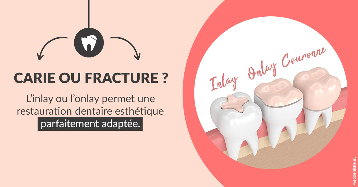 https://dr-feredj-elisabeth.chirurgiens-dentistes.fr/T2 2023 - Carie ou fracture 2