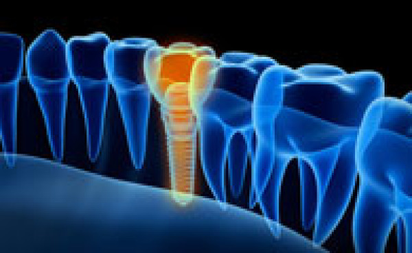 Qu'est-ce qu'un implant dentaire ? Indications et contre-indications