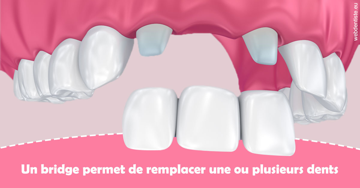 https://dr-feredj-elisabeth.chirurgiens-dentistes.fr/Bridge remplacer dents 2
