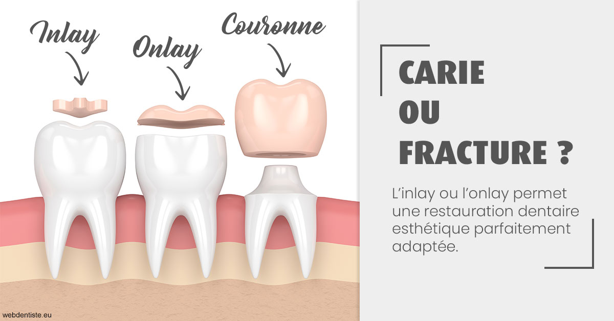 https://dr-feredj-elisabeth.chirurgiens-dentistes.fr/T2 2023 - Carie ou fracture 1