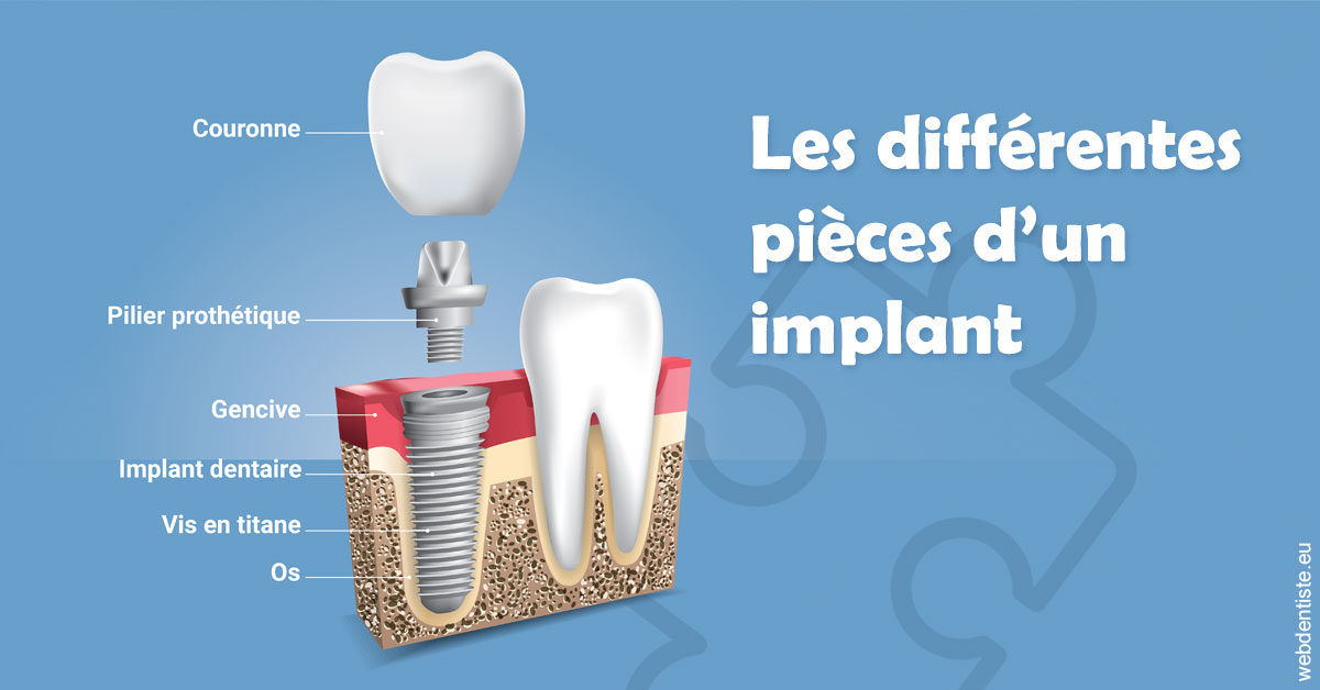 https://dr-feredj-elisabeth.chirurgiens-dentistes.fr/Les différentes pièces d’un implant 1