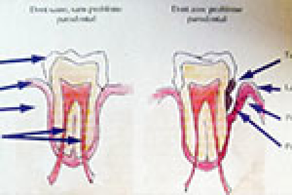 Assainissement des gencives par traitement parodontal non chirurgical