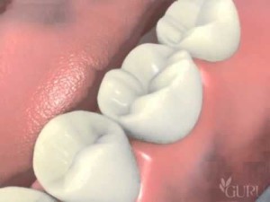 Couronne sur implant dentaire